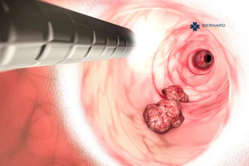 Q&A: 6 vấn đề cần quan tâm về ung thư đại tràng sigma